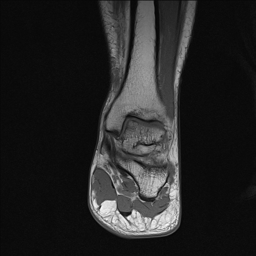 File:Achilles tendon tear (Radiopaedia 77615-89819 Coronal T1 15).jpg