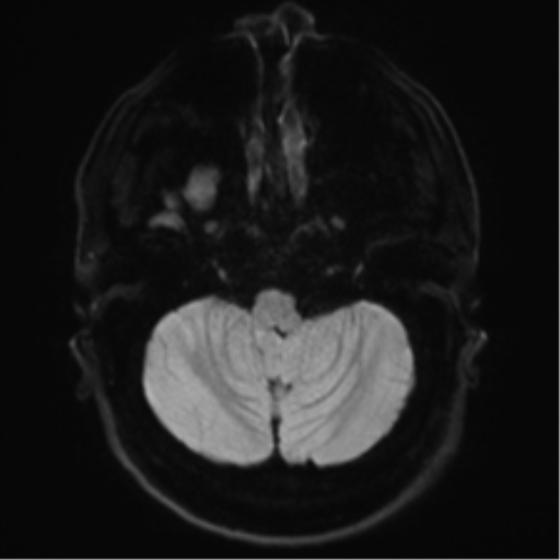 File:Achondroplasia (Radiopaedia 65109-74105 Axial DWI 3).png