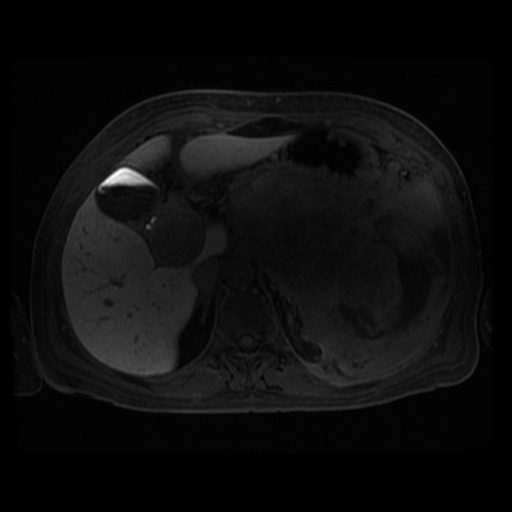 Acinar cell carcinoma of the pancreas (Radiopaedia 75442-86668 Axial late phase (~30 mins) 82).jpg