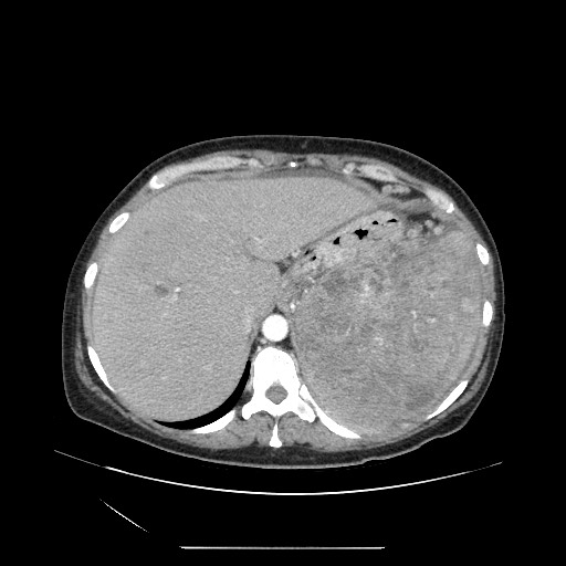 Acinar cell carcinoma of the pancreas (Radiopaedia 75442-86669 Axial C+ portal venous phase 25).jpg