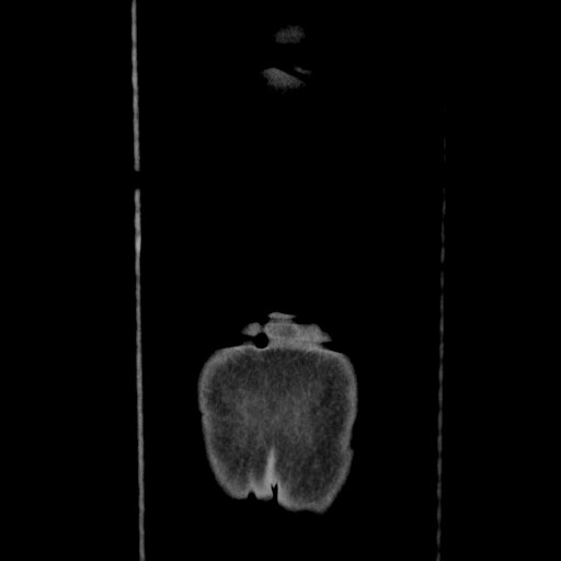 Acinar cell carcinoma of the pancreas (Radiopaedia 75442-86669 Coronal C+ portal venous phase 127).jpg