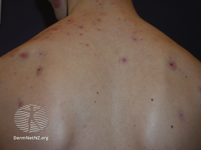 File:Acne affecting the back images (DermNet NZ acne-acne-back-148).jpg