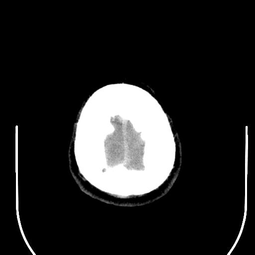 File:Acoustic schwannoma (Radiopaedia 29488-29982 AXIAL THICK non-contrast 46).jpg