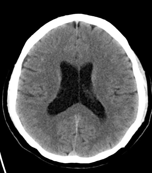 File:Acoustic schwannoma (Radiopaedia 33045-34065 Axial non-contrast 16).png