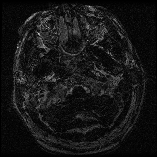 File:Acoustic schwannoma (Radiopaedia 39170-41387 Axial FIESTA 5).png