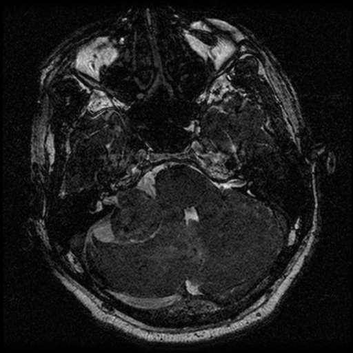 File:Acoustic schwannoma (Radiopaedia 39170-41387 Axial FIESTA 69).png