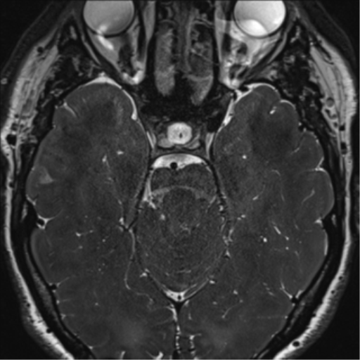 File:Acoustic schwannoma (Radiopaedia 50846-56358 Axial T2 35).png