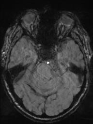 Acoustic schwannoma (Radiopaedia 55729-62281 Axial SWI 17).png