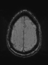 Acoustic schwannoma (Radiopaedia 55729-62281 Axial SWI 44).png