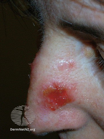 Actinic Keratoses treated with imiquimod (DermNet NZ lesions-ak-imiquimod-3759).jpg