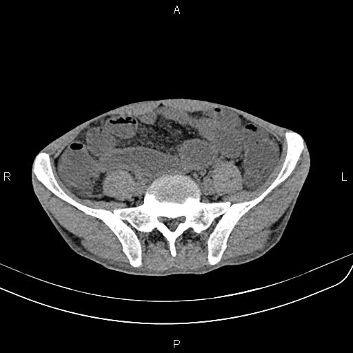 Active crohn disease (Radiopaedia 87133-103397 Axial non-contrast 73).jpg
