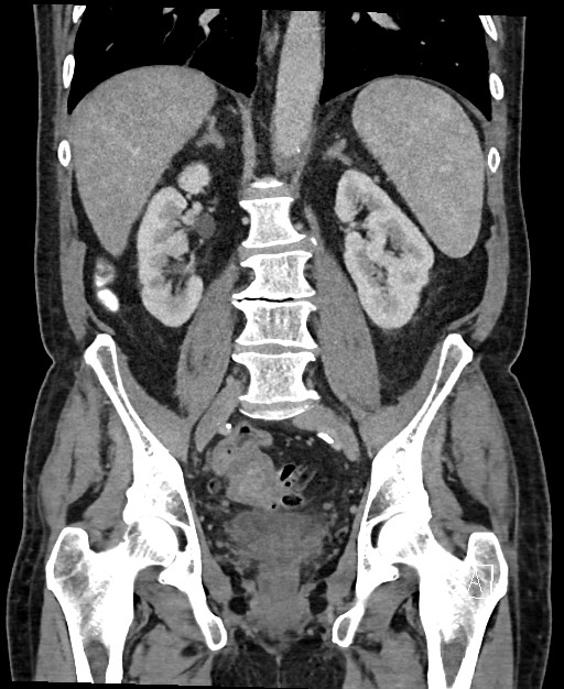 Active lower gastrointestinal bleeding - diverticular (Radiopaedia 61203-69106 Coronal C+ portal venous phase 85).jpg