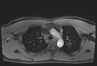 Active right ventricular cardiac sarcoidosis (Radiopaedia 55596-62100 Axial Post contrast Dixon 14).jpg