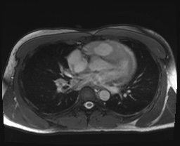 File:Active right ventricular cardiac sarcoidosis (Radiopaedia 55596-62100 Axial SSFP 11).jpg