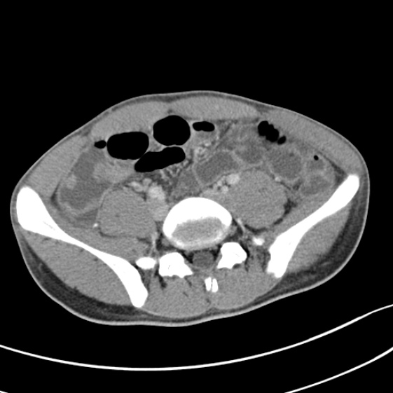 File:Acute appendicitis (Radiopaedia 32614-33572 Axial C+ portal venous phase 45).jpg