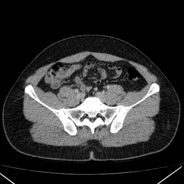 File:Acute appendicitis (Radiopaedia 38255-40270 Axial C+ portal venous phase 80).jpg