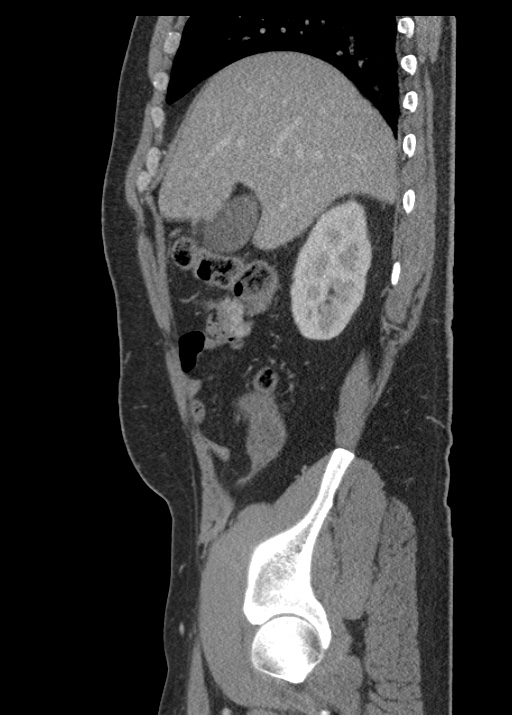 Acute appendicitis (Radiopaedia 48511-53463 Sagittal C+ portal venous phase 42).jpg