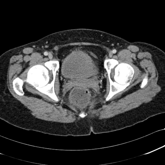 Acute appendicitis (Radiopaedia 48792-53822 Axial C+ portal venous phase 113).jpg