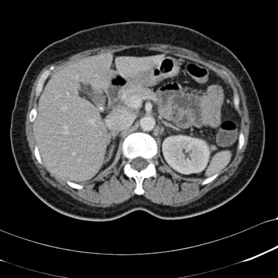 File:Acute appendicitis (Radiopaedia 48792-53822 Axial C+ portal venous phase 34).jpg
