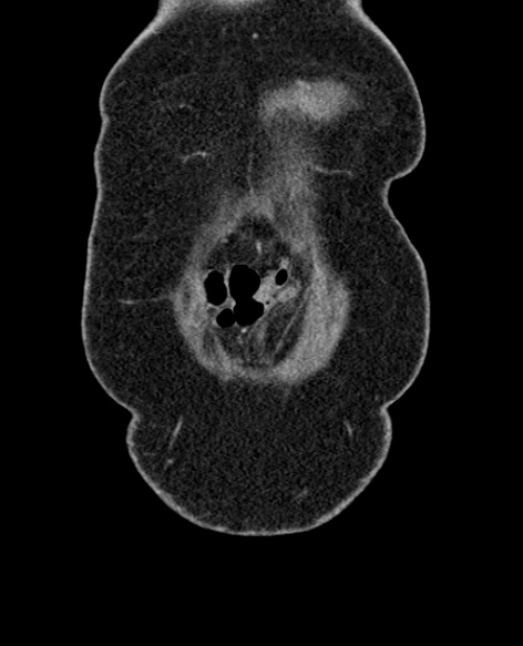 File:Acute appendicitis (Radiopaedia 48792-53822 Coronal C+ portal venous phase 19).jpg