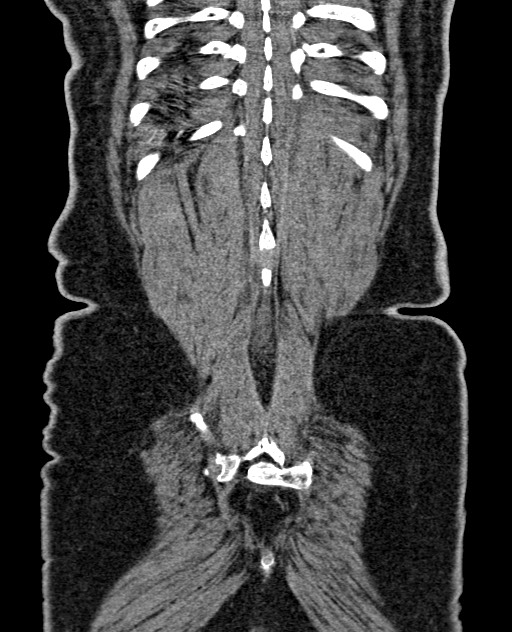 Acute appendicitis (Radiopaedia 58627-65818 Coronal non-contrast 59).jpg