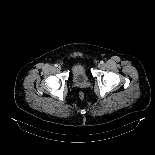 File:Acute appendicitis (Radiopaedia 79950-93224 Axial C+ portal venous phase 97).jpg