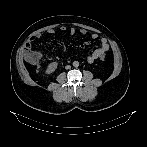 File:Acute appendicitis (Radiopaedia 79950-93224 Axial non-contrast 57).jpg
