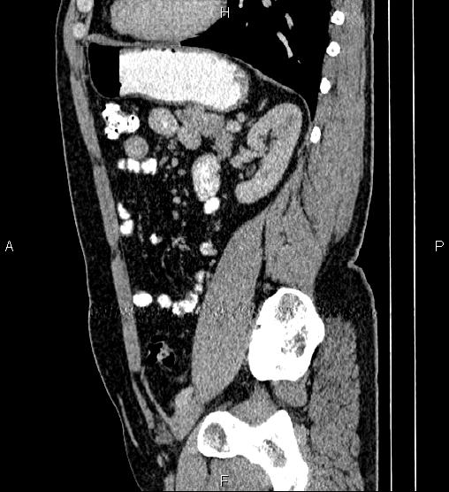 Acute appendicitis (Radiopaedia 84780-100240 Sagittal C+ portal venous phase 72).jpg
