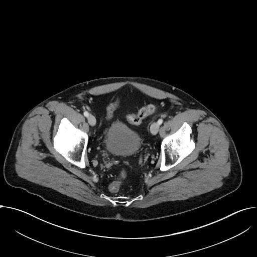 File:Acute appendicitis - large appendicoliths (Radiopaedia 61805-69820 Axial C+ portal venous phase 115).jpg