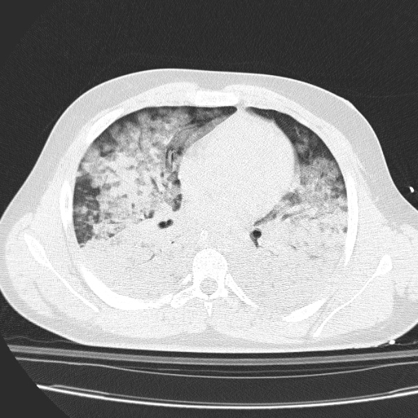 Acute aspiration pneumonitis (Radiopaedia 33605-34703 Axial lung window 53).jpg