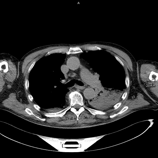 File:Acute aspiration pneumonitis (Radiopaedia 55642-62166 Axial liver window 26).jpg
