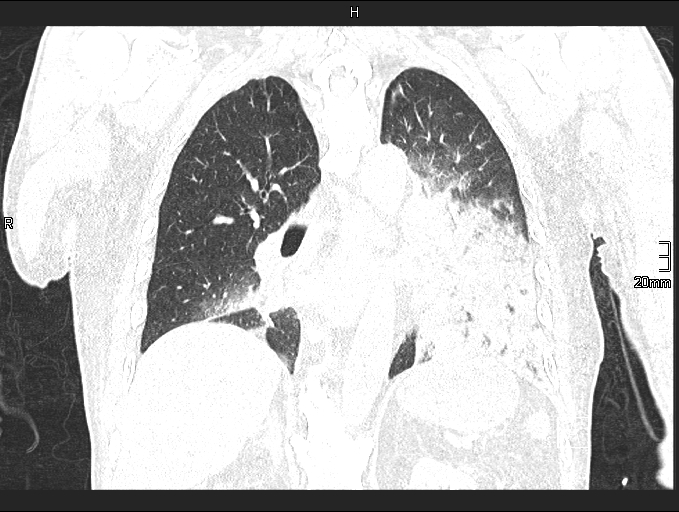 Acute aspiration pneumonitis (Radiopaedia 55642-62166 Coronal lung window 65).jpg