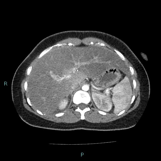 File:Acute bilateral pyelonephritis (Radiopaedia 37146-38881 Axial C+ arterial phase 42).jpg
