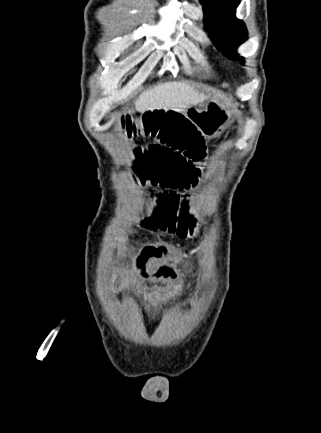 Acute bowel ischemia (Radiopaedia 87695-104114 Coronal C+ portal venous phase 83).jpg