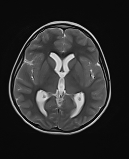 File:Acute cerebellar ataxia (Radiopaedia 61487-69446 Axial T2 12).jpg