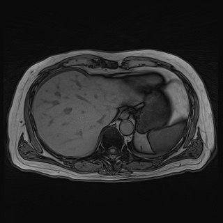 File:Acute cholecystitis (Radiopaedia 72392-82923 Axial T1 out-of-phase 30).jpg