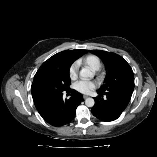 Acute cholecystitis and incidental left sided IVC (Radiopaedia 49352-54459 Axial C+ portal venous phase 6).jpg