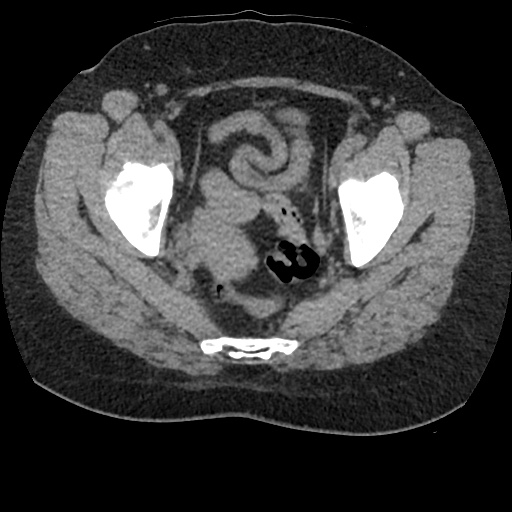 Acute cholecystitis and ureteric colic (Radiopaedia 42330-45444 Axial prone 97).jpg