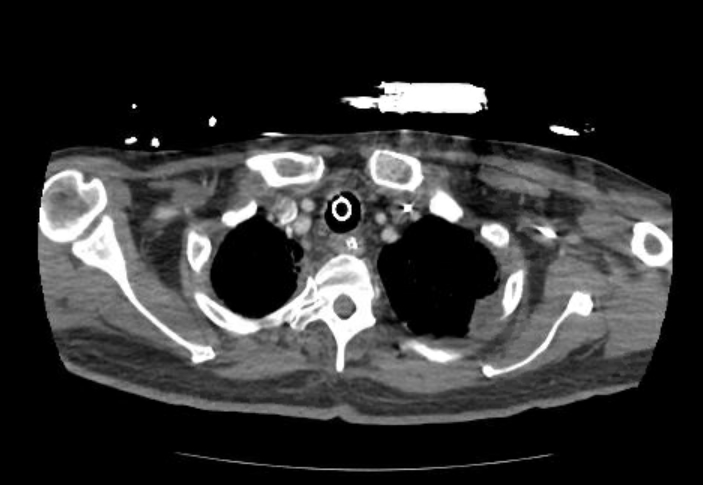 Acute cor pulmonale (ultrasound) (Radiopaedia 83508-98818 Axial C+ CTPA 3).jpg