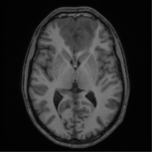 Acute disseminated encephalomyelitis (ADEM) (Radiopaedia 65319-74349 Axial T1 33).png