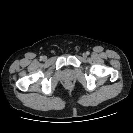 Acute diverticulitis with localized perforation (Radiopaedia 41296-44113 Axial C+ portal venous phase 92).jpg