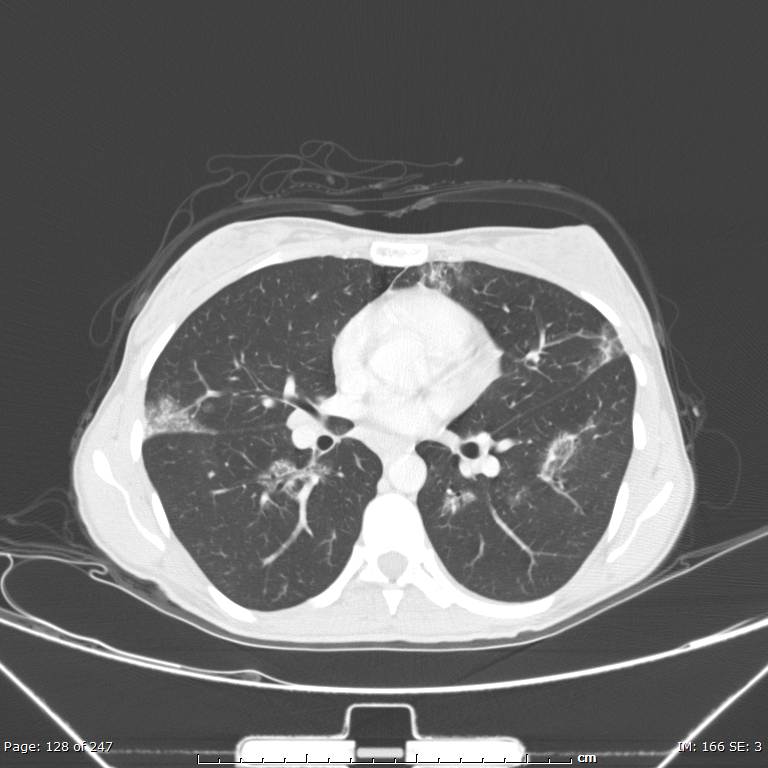 Acute eosinophilic pneumonia (Radiopaedia 48211-53073 Axial lung window 46).jpg
