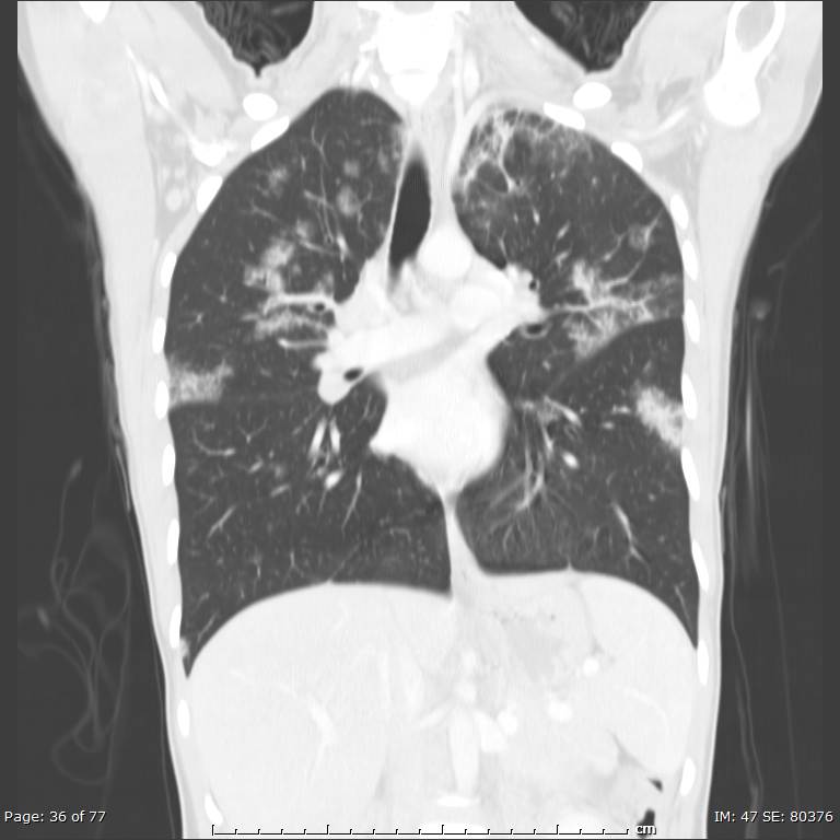 Acute eosinophilic pneumonia (Radiopaedia 48211-53073 Coronal lung window 24).jpg