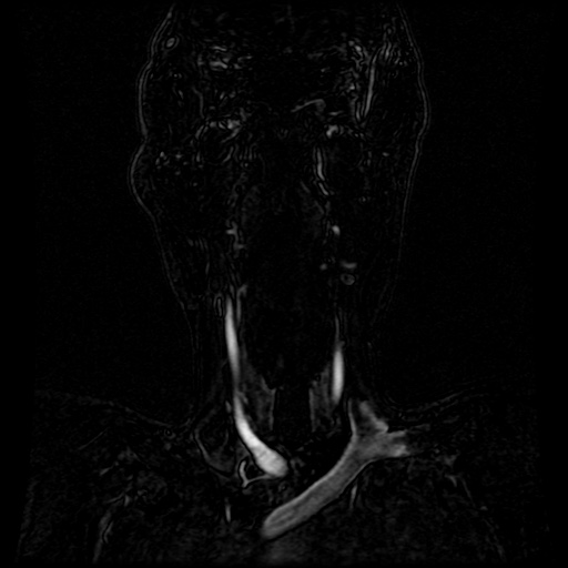 Acute internal carotid artery dissection (Radiopaedia 53541-59632 Coronal MRA 72).jpg