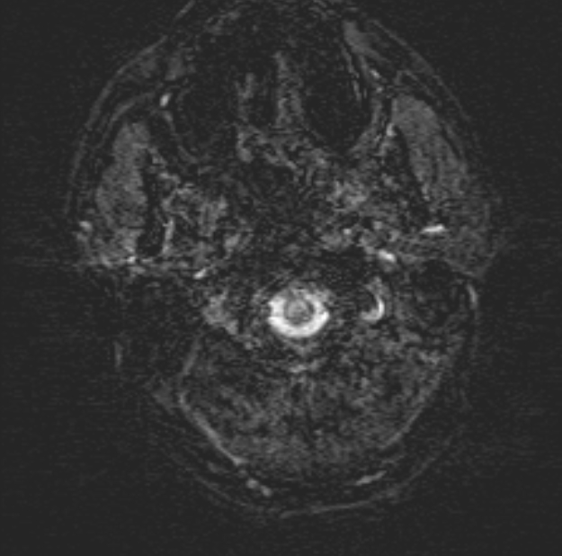 Acute ischemic stroke - posterior circulation territory (Radiopaedia 77670-89880 Axial SWI 2).jpg