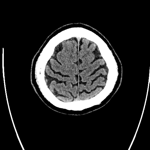 File:Acute left middle cerebral artery territory ischemic stroke (Radiopaedia 35688-37223 Axial non-contrast 74).png