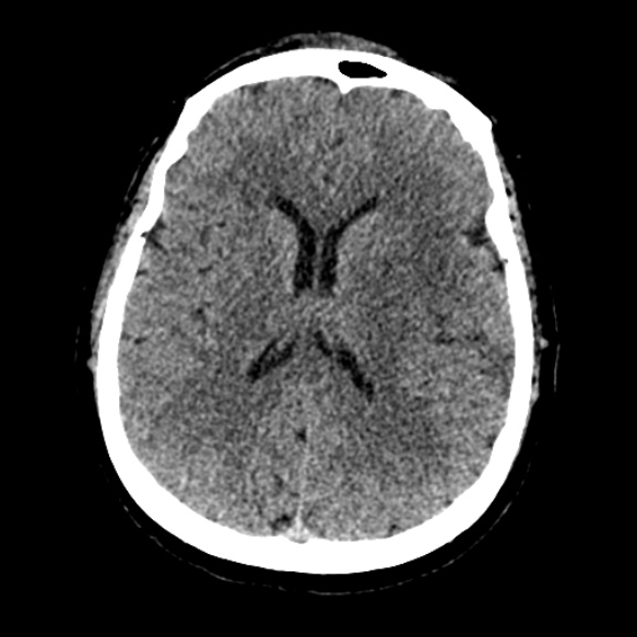 Acute middle cerebral artery territory infarct (Radiopaedia 52380-58283 Axial non-contrast 61).jpg