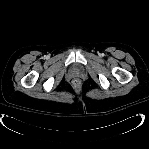 Acute myocardial infarction in CT (Radiopaedia 39947-42415 Axial C+ portal venous phase 139).jpg
