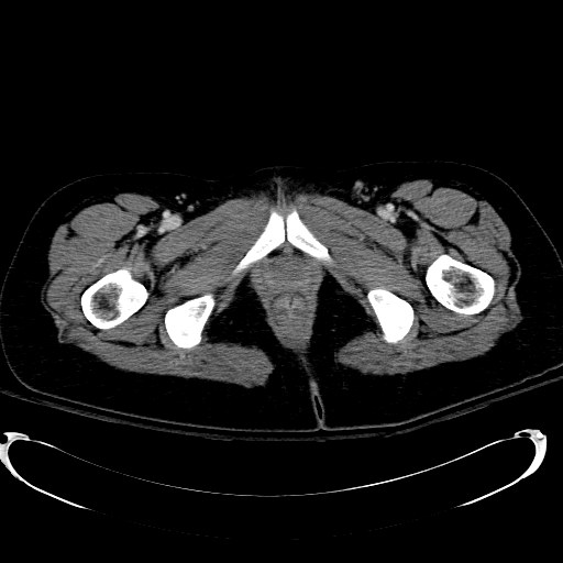 Acute myocardial infarction in CT (Radiopaedia 39947-42415 Axial C+ portal venous phase 143).jpg