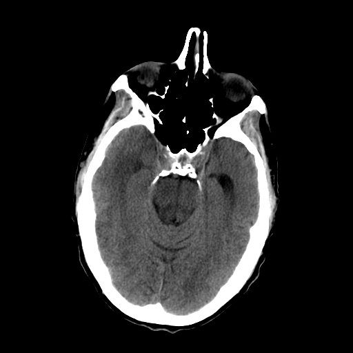 File:Acute necrotizing toxoplasma encephalitis (Radiopaedia 10683-11150 Axial non-contrast 23).jpg